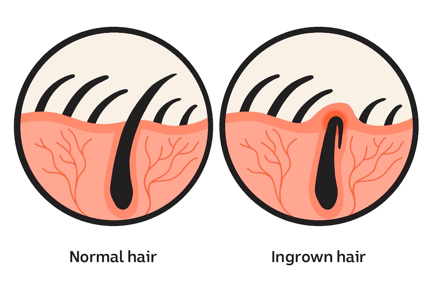 One diagram shows a normal hair growing out of the skin, while another shows an ingrown hair trapped under the skin.