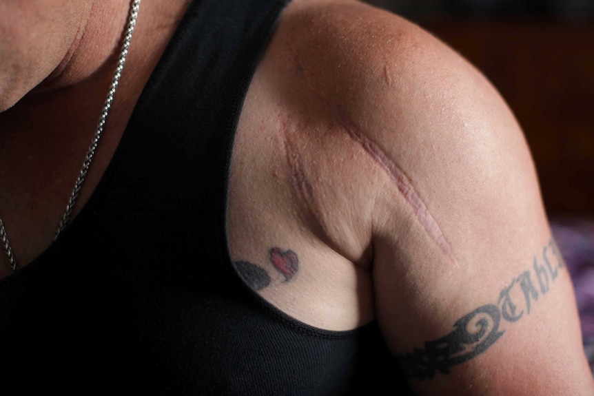 Wolfgang Neszpor's scars from shoulder surgery