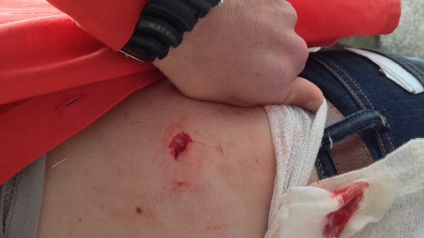Scott Berry sustained a shark bite at Parsons Beach near Victor Harbor on June 9, 2014.