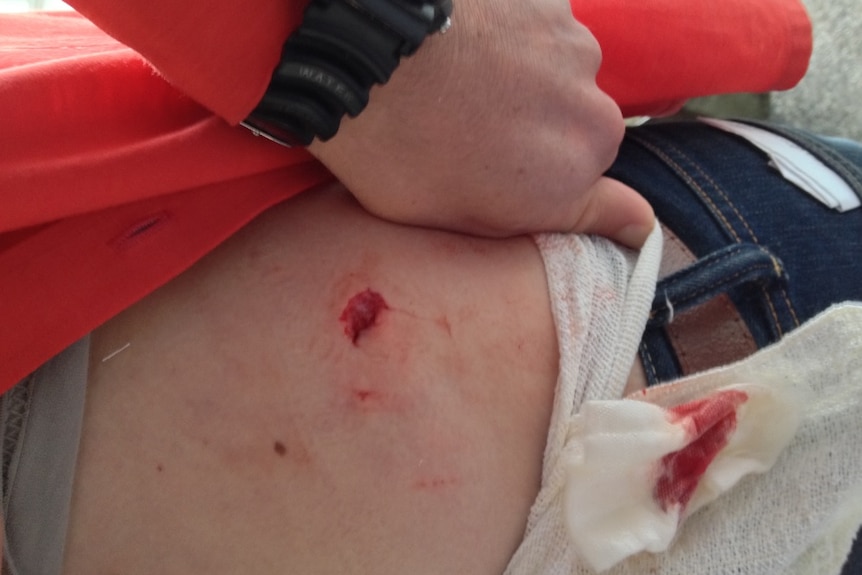 Scott Berry sustained a shark bite at Parsons Beach near Victor Harbor on June 9, 2014.