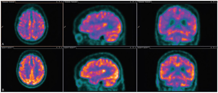 Two rows of PET scans of brans before and after delirium.