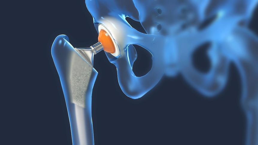 An illustration of a right hip replacement