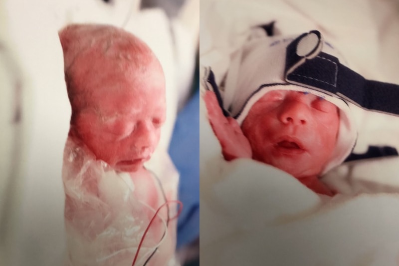 A composite image of two premature babies