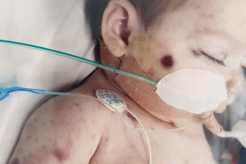 A baby covered in a rash in a hospital bed.