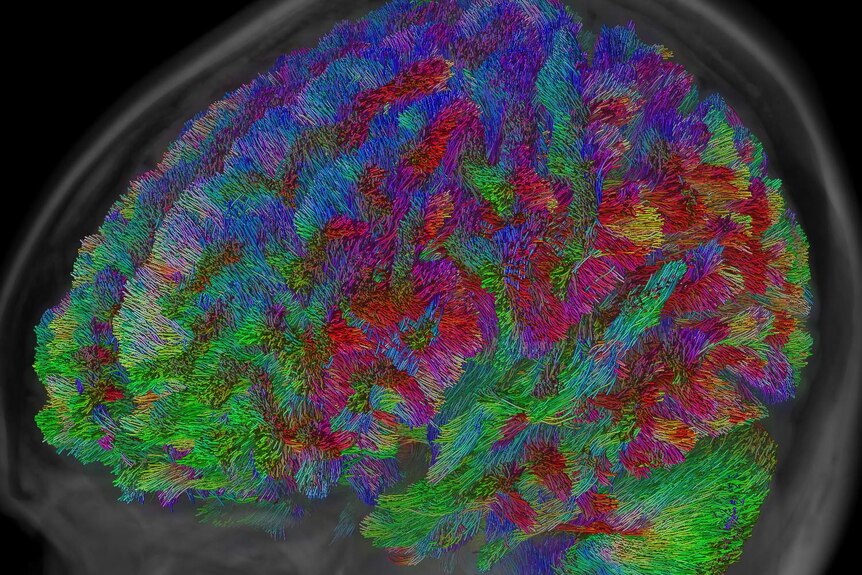 3D scan showing coloured brain tracts
