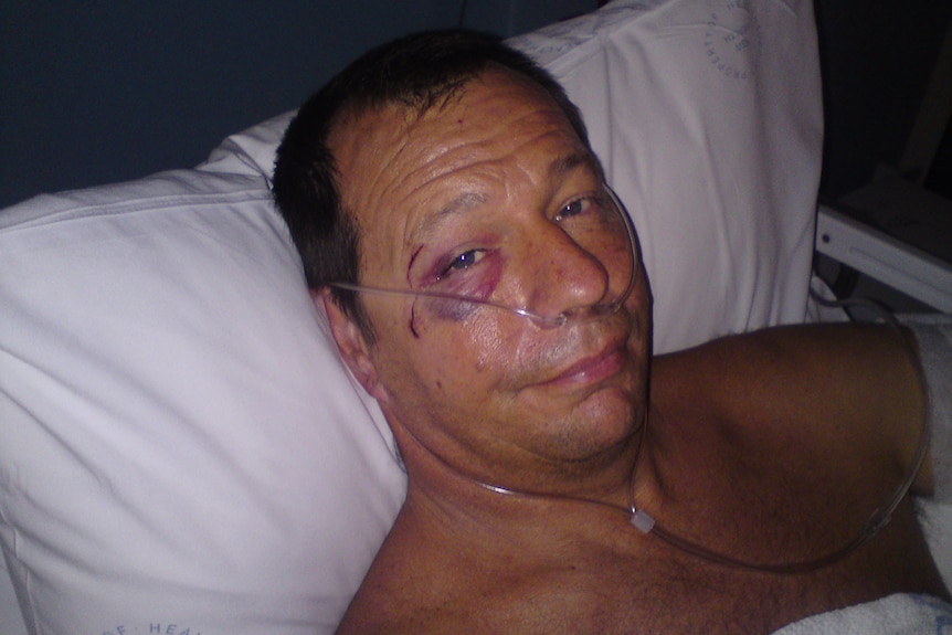 He has a black eye and a tube up his nose and is lying in a hospital bed