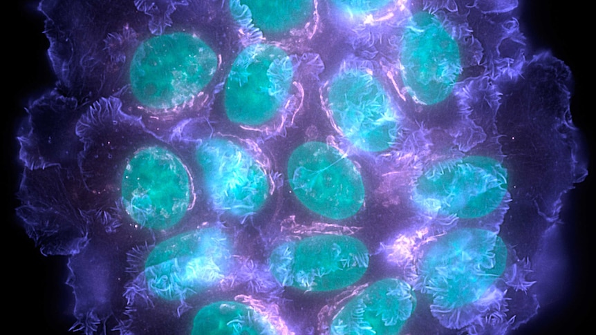 Breast cancer cells.