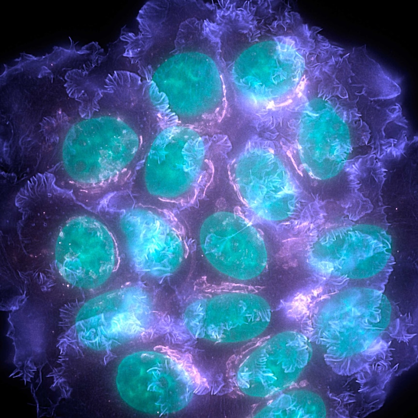 Breast cancer cells