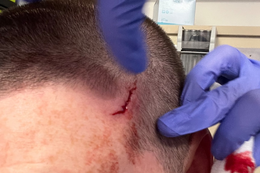 Deep cut about two inches long on a man's forehead on hairline