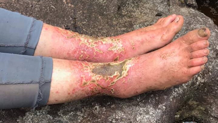 A woman's feet are red with scabs and sores on them