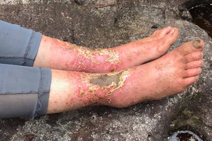 A woman's feet are red with scabs and sores on them