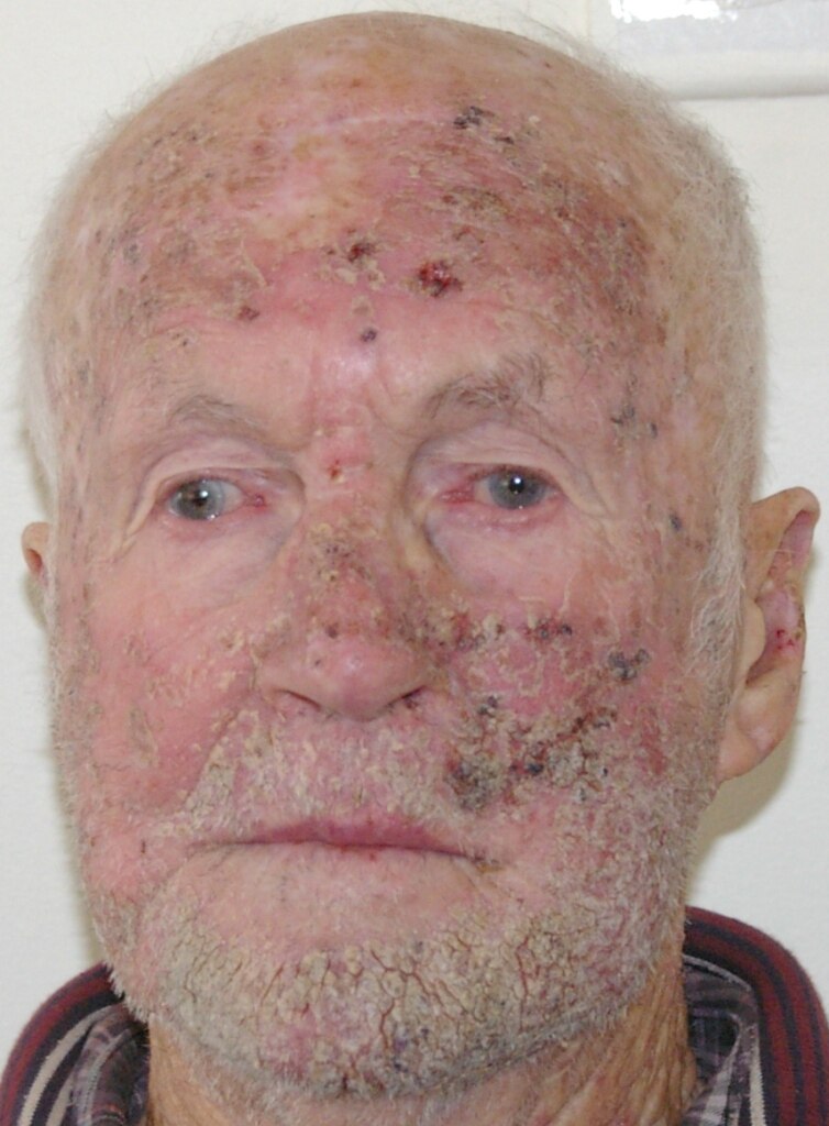 Concerns Raised Over Ala Skin Cancer Cream As Patients Recount Horrendous Pain Abc News