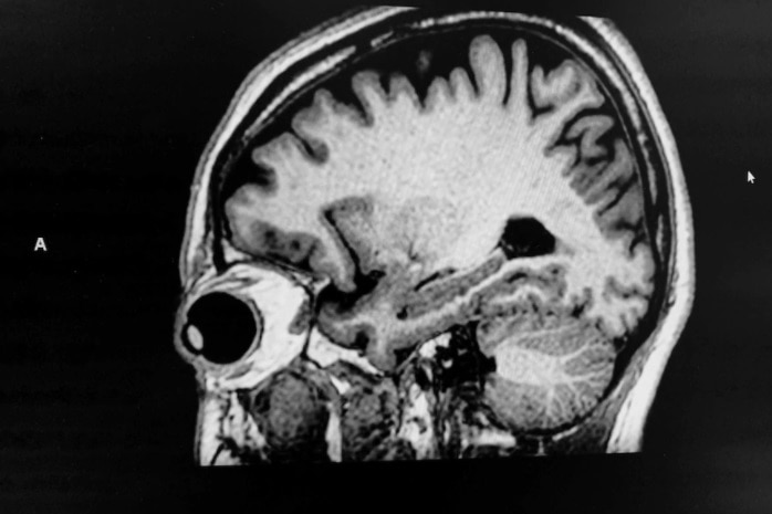 A black and white brain scan