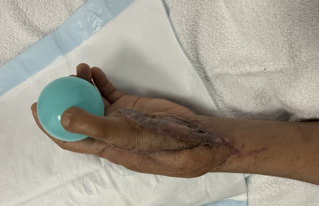 'Tears of joy': Woman’s lost thumb replaced with second toe