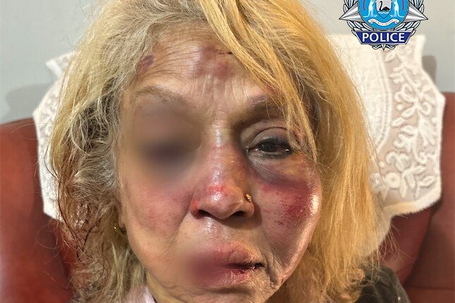 Close-up of the shocking facial injrues suffered by a 73-year-old woman, partially blurred.