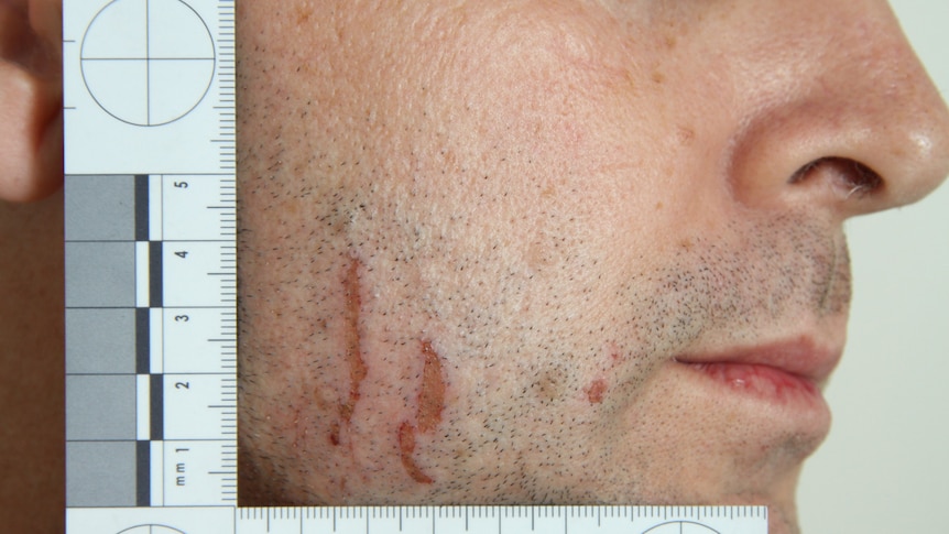 A photo shows marks on the face of accused murderer Gerard-Baden Clay.