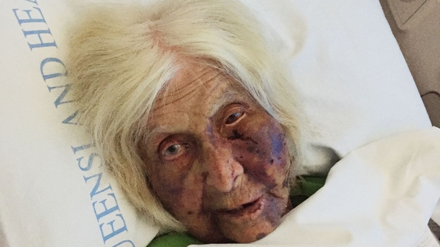 Clare Alexa Wilson, then 92, lies in a bed with facial injuries, recovering from being attacked in her home.