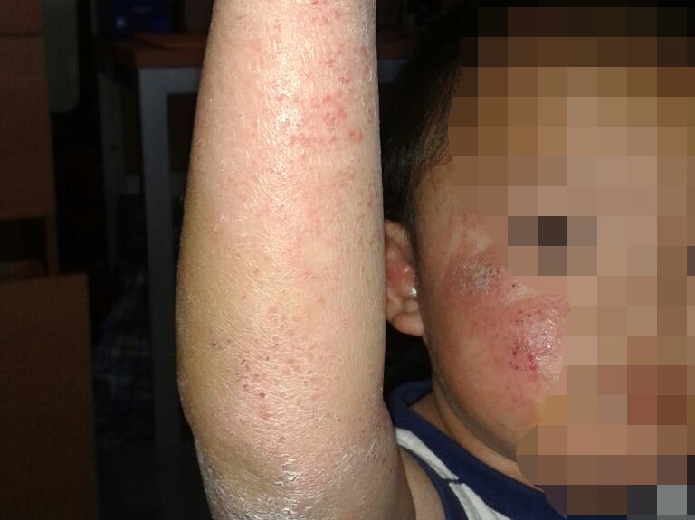 Asylum seeker boy's skin condition