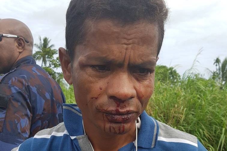 A Bangladeshi refugee on Manus Island has a bloodied face after an alleged attack by locals.