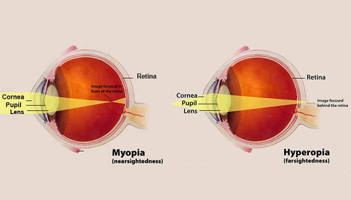 Illustration of myopia and hyperopia