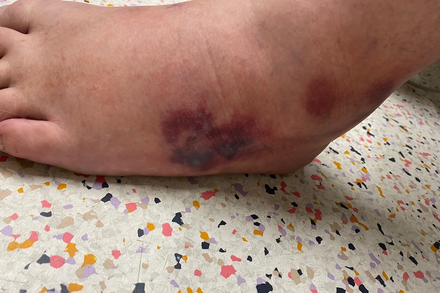 A red mark on Greg Hislop's infected foot