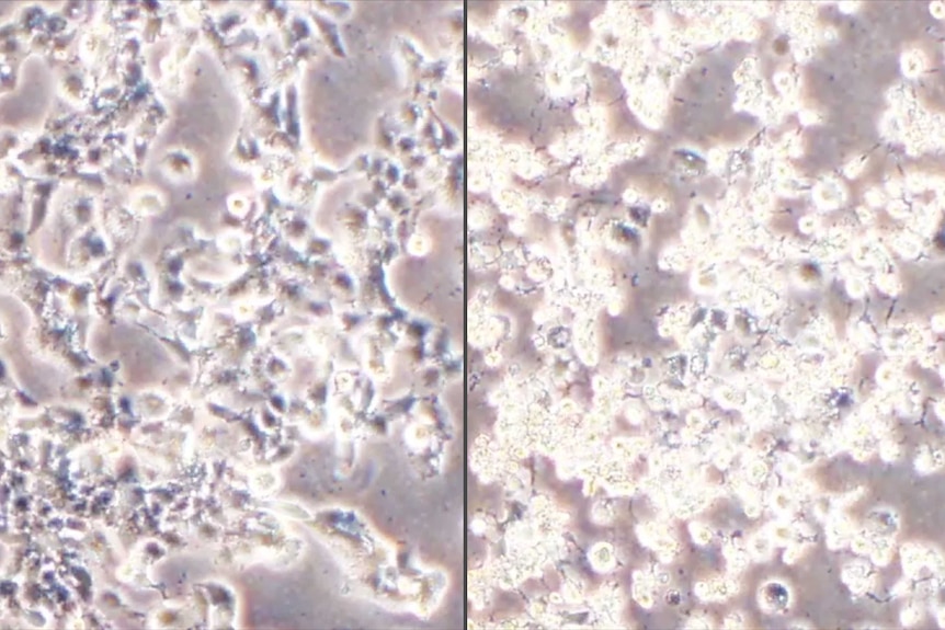 Two images showing cancer cells under a microscope