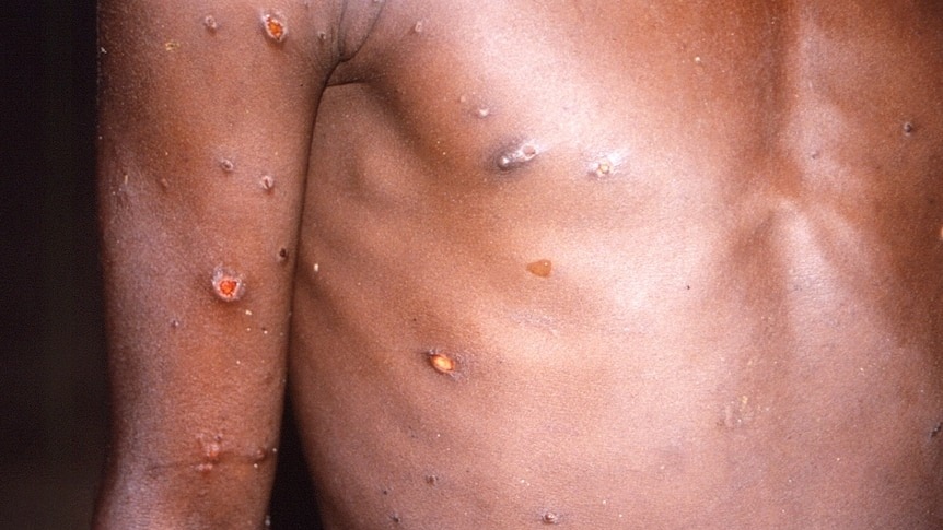 The arms and torso of a patient with skin lesions