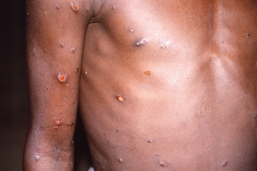The arms and torso of a patient with skin lesions