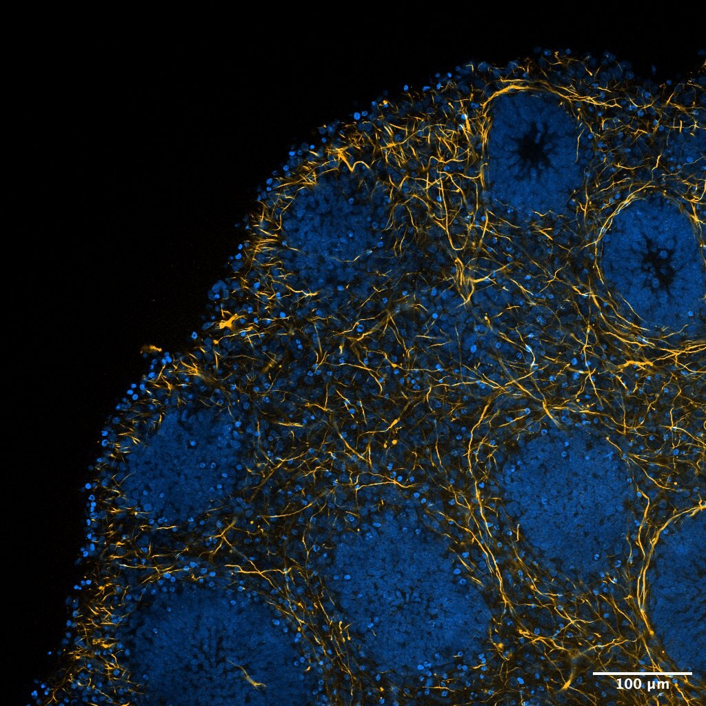 A picture of brain tissue from an epilepsy patient.