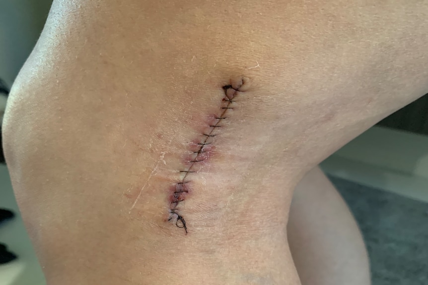 a cut on a leg stitched up 