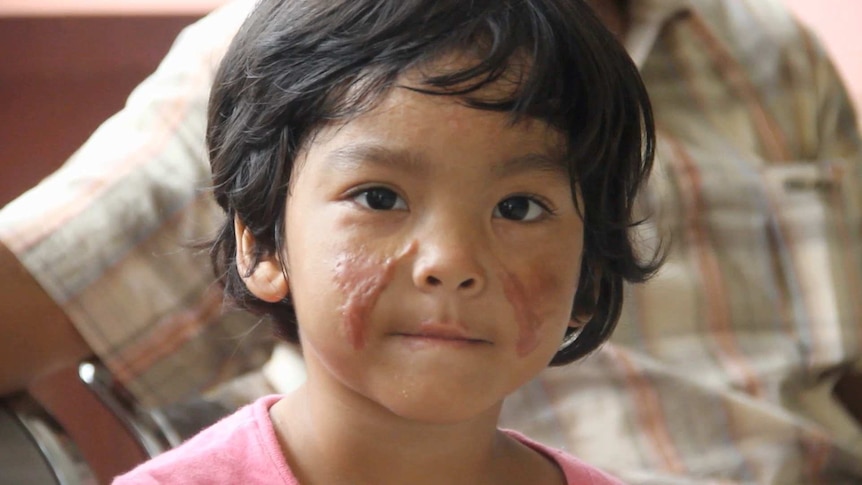 Trinity Hutahaean has permanent scarring on her face from the attack