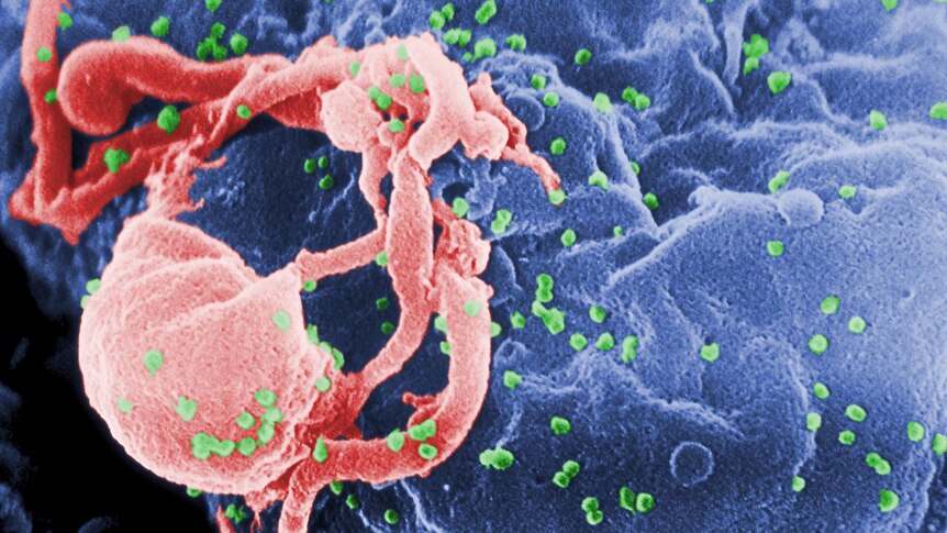 HIV-1, coloured green, budding from a cultured lymphocyte.