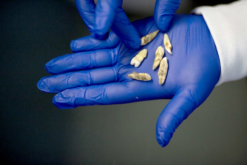 A gloved hands holds human teeth.