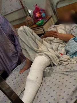 A man with a bandage on his entire leg lying in a bed
