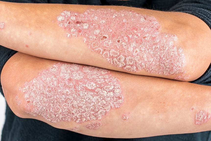 Arms covered with psoriasis skin plaques