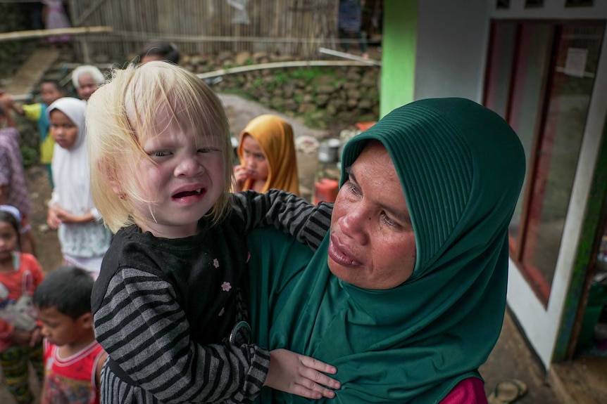 Nur Hayati's three-year-old daughter Winda is albino, but her two older children are not.