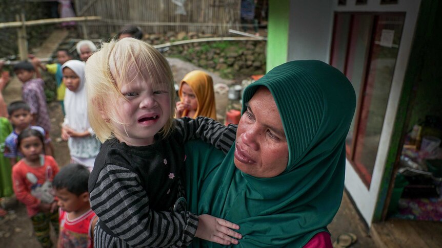 Nur Hayati's three-year-old daughter Winda is albino, but her two older children are not.