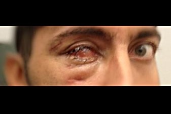 The asylum seeker now has a prosthetic eye as a result of his injuries.