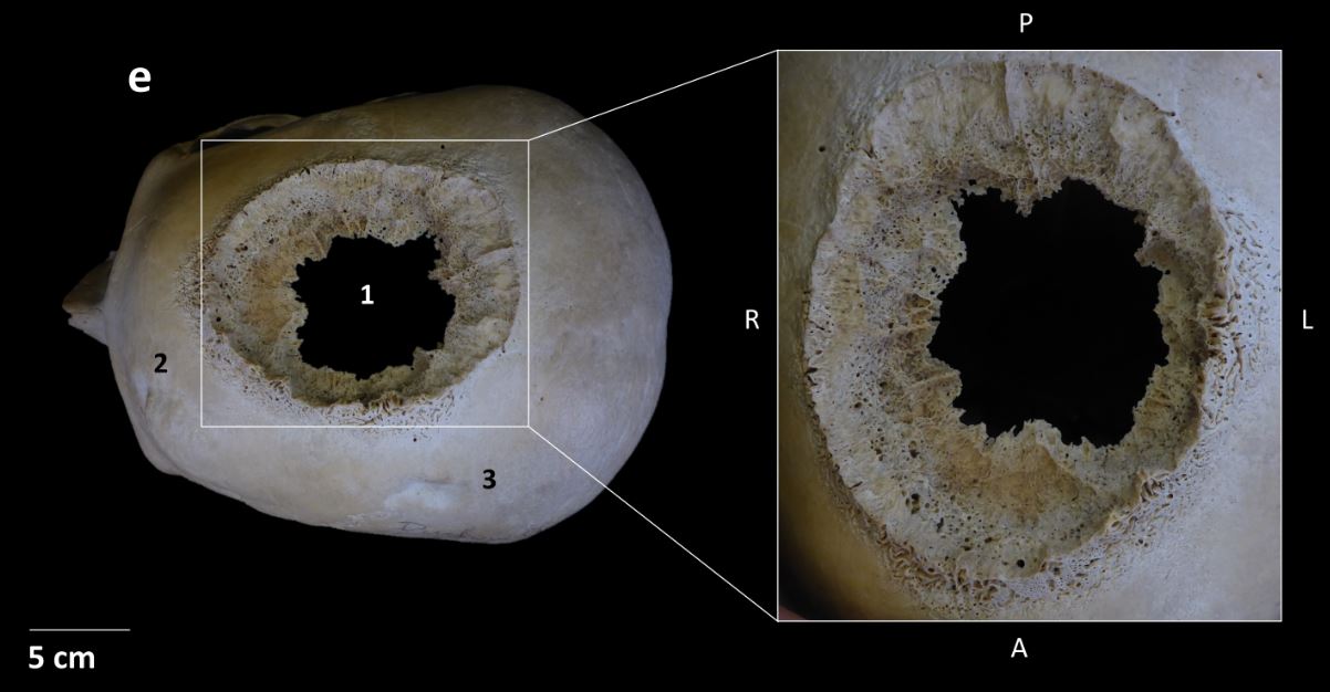 A skull with a great big hole in the top. 