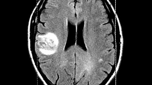 Brain scan showing David Hall's tumour.