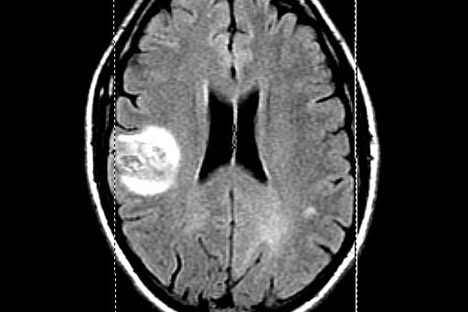 Brain scan showing David Hall's tumour.