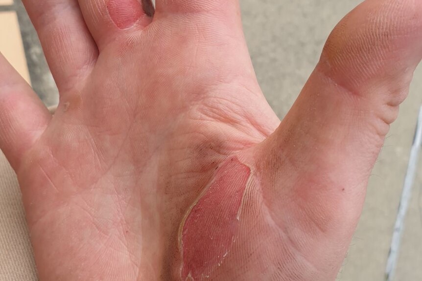 Hands with blisters, the skin is worn away and red on the palm near the thumb.