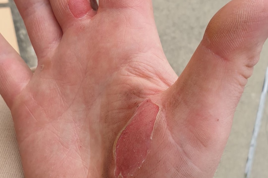 Hands with blisters, the skin is worn away and red on the palm near the thumb.