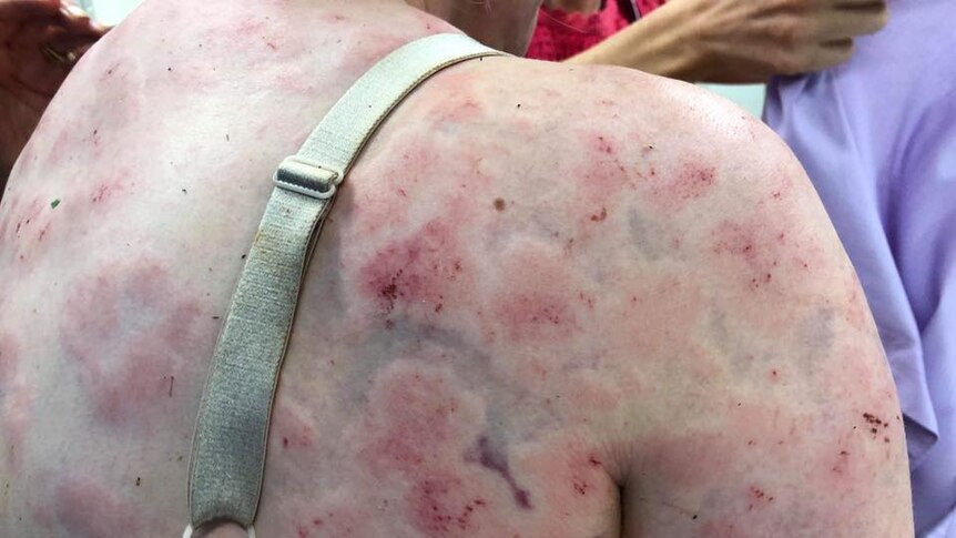 Close-up shot of a woman's back showing bruising after being struck by hail.