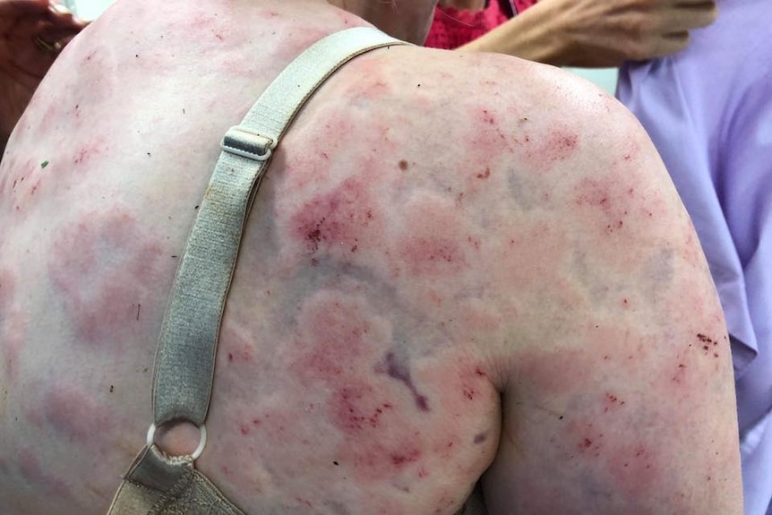 Close-up shot of a woman's back showing bruising after being struck by hail.