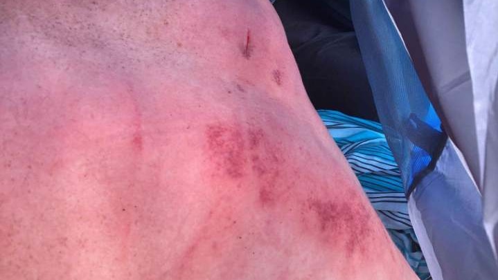 A man shows red marks and cuts on his back after beingrun over by a car at Falls Festival.