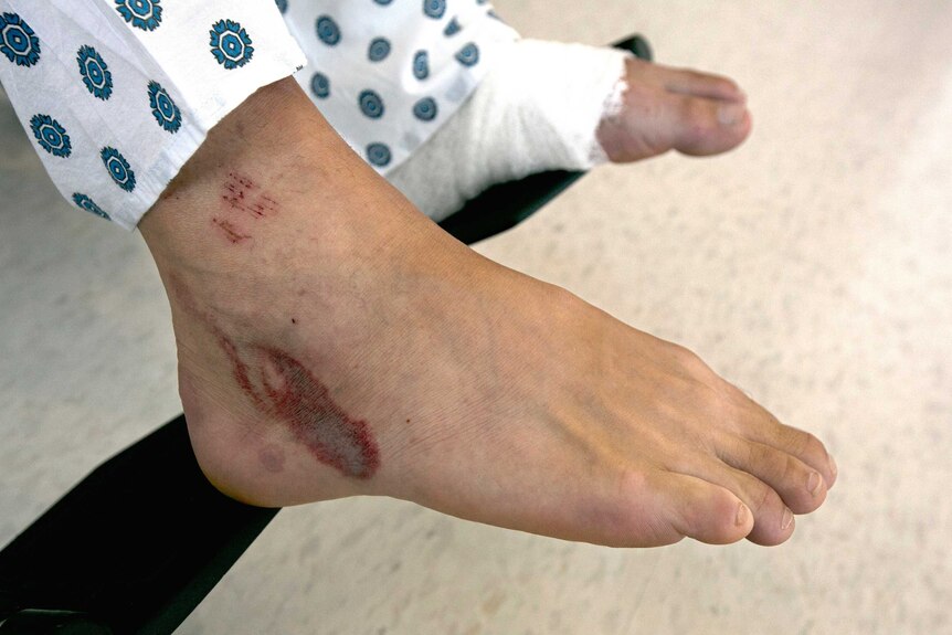 A large burn mark about 2 inches in diametre brandishes a mans right foot