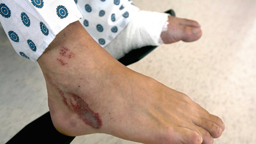 A large burn mark about 2 inches in diametre brandishes a mans right foot