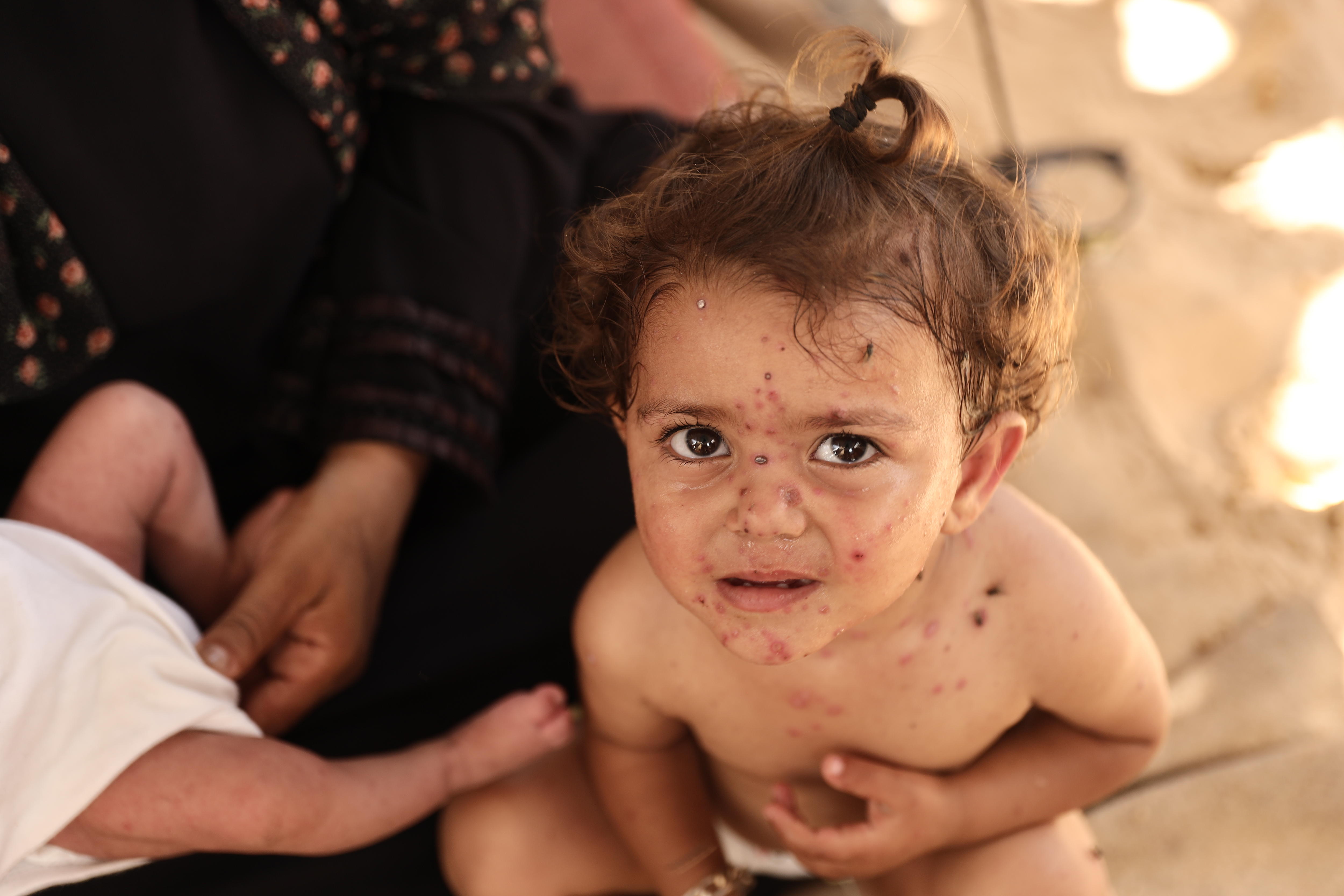 'Her skin is bleeding': Devastating virus wreaks havoc in Gaza