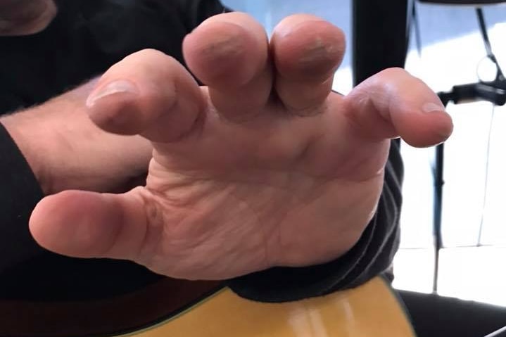 Close up on the outstretched hand of a man holding a guitar showing his cracked, swollen fingers.